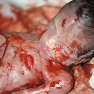abortion
