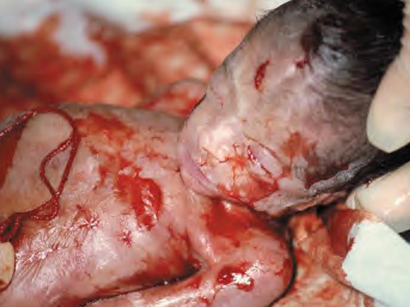 abortion